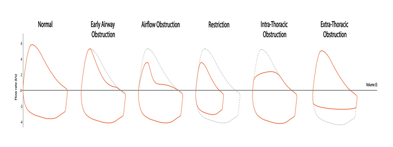 You are currently viewing Interpreting Abnormal Lung Function Results: What Do They Mean?