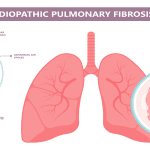 Read more about the article The Role of Pulmonary Rehabilitation in Improving Lung Capacity