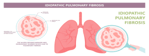 Read more about the article The Role of Pulmonary Rehabilitation in Improving Lung Capacity