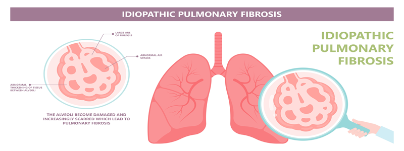 You are currently viewing The Role of Pulmonary Rehabilitation in Improving Lung Capacity