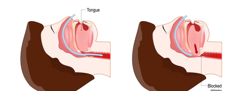 You are currently viewing Sleep Apnea and Its Effect on Lung Function