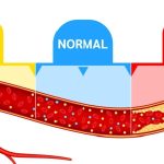 Read more about the article High Cholesterol and Heart Disease: Understanding the Connection